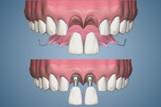 Complete Anterior Implant Procedure 2 Stage